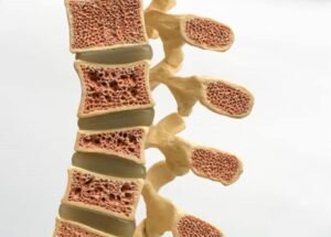 fratura do corpo vertebral por insuficiência