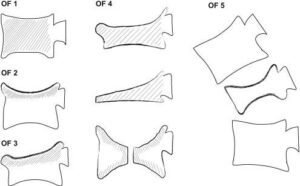 classificação de fraturas osteoporóticas da German Society for Orthopaedics and Trauma. O tratamento de vertebroplastia e cifoplastia é mais indicado nos tipos OF3 e OF4. (fonte artigo 2)