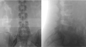 Imagem de frente e perfil de uma radioscopia para infiltração transforaminal no nível L5-S1. Observe a agulha localizada no nível L5-S1 e o contraste confirmando o correto posicionamento da agulha próximo à raiz de L5.