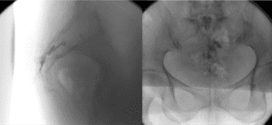 Infiltração epidural pelo forame sacral guiada por radioscopia e confirmação com contraste.