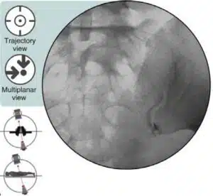 Imagens: imagens demonstram desenho com as estruturas da região da sacroilíaca e radioscopia do procedimento de infiltração.