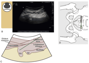 Imagem: infiltração da sacroilíaca guiada por ultrassom.