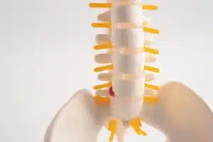 Fragmento de hérnia de disco deslocado na coluna lombar, nervo espinhal e osso.