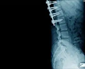 Vista lateral da estrutura óssea com fixação interna para prevenir a compressão da coluna vertebral.