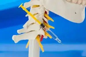 Conceito de infiltração na coluna