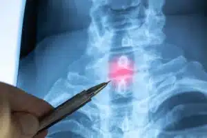 Médico indicando lesão na cervical
