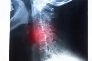 Raio-X de uma coluna cervical