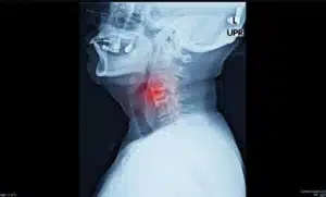 Imagem de raio-X do pescoço, destacando a região da coluna cervical onde foi realizada a artrodese cervical via anterior.