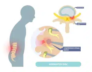Ilustração anatômica da coluna vertebral destacando estruturas entre as vértebras e alterações que podem estar relacionadas à dor nas costas. A imagem complementa o conteúdo sobre tratamento para artrose facetária, ajudando a compreender a anatomia da coluna e as estruturas envolvidas.