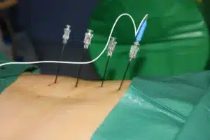 Paciente recebendo o tratamento de rizotomia por radiofrequência na coluna.